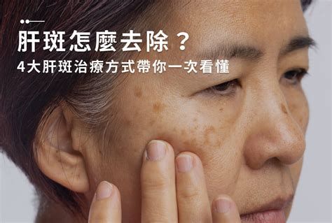 腳背長斑|一次解析曬斑、肝斑、雀斑、顴骨母斑等皮膚黑斑原因…